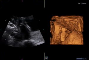 4D ultrazvuk za trudnice