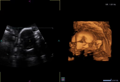 4D ultrazvuk za trudnice